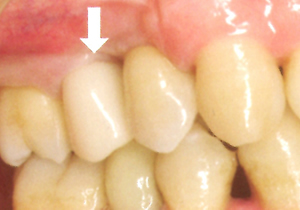 CAD/CAM冠ハイブリッドセラミックスとは