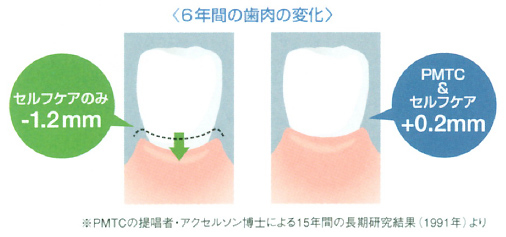 歯ぐきを健康な状態に保ちます。