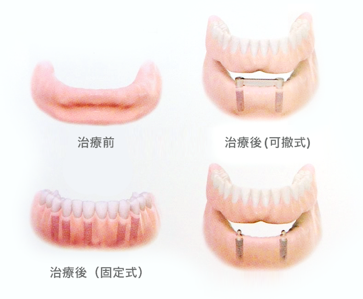 歯を全て失った場合