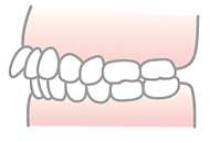 上顎前突（じょうがくぜんとつ）