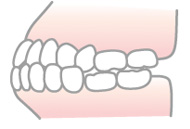 上下顎前突（じょうかがくぜんとつ）