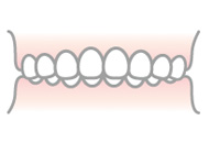 過蓋咬合（かがいこうごう）