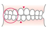 交叉咬合(こうさこうごう）