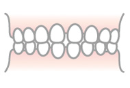 空隙歯列（くうげきしれつ）