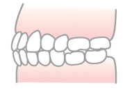 切端咬合（せったんこうごう）