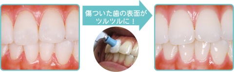 傷ついた歯の表面がツルツルに!