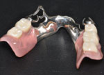 精密金属義歯
